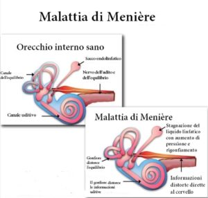 sindrome di meniere cause