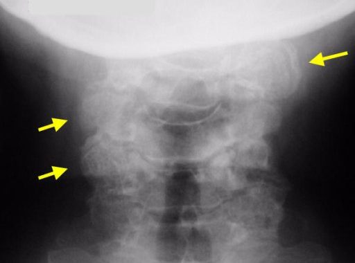 radiografia artrosi cervicale