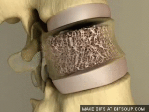 gif vertebra osteoporosi