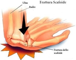 frattura dello scafoide