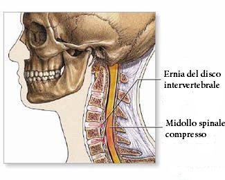 Ernia cervicale scheletro