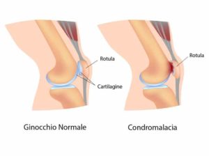 Condromalacia Rotula