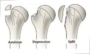 frattura del trochite omerale