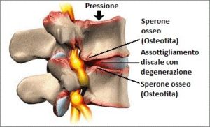 osteofiti cervicali