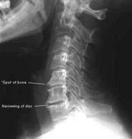 osteofita cervicale rx