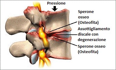 Osteofiti Cervicali