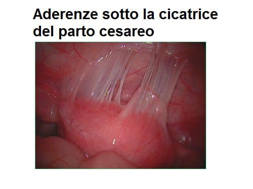 aderenze parto cesareo