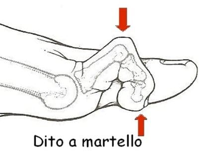 dito a martello