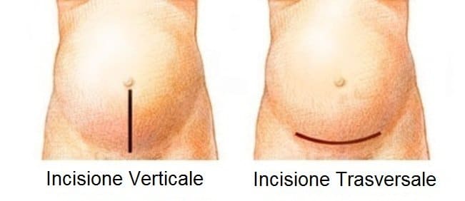 incisione parto cesareo