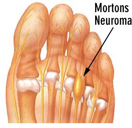 neuroma di morton