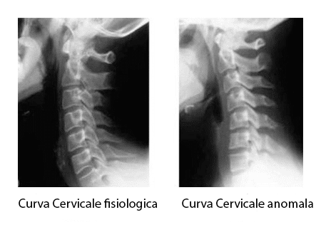 curva cervicale anomala