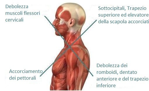 sindrome crociata superiore