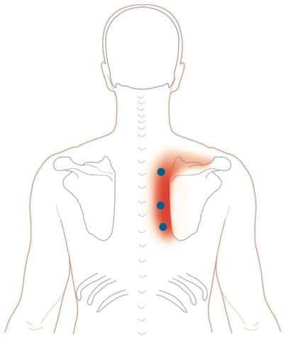 trigger point romboidi