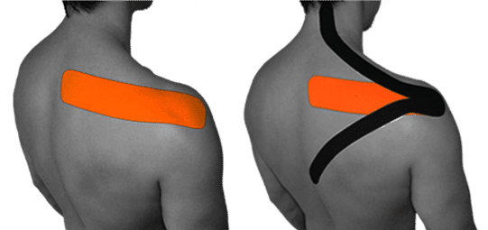 trapezio taping