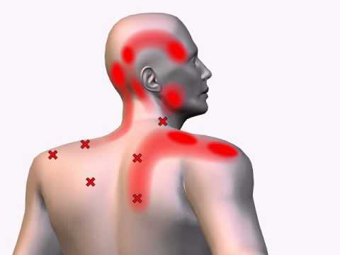 trigger point trapezio