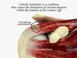 calcificazione tendini