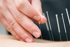 dry needling spalla