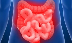 colon irritabile