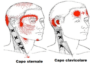 area di dolore da trigger point