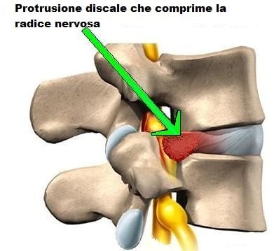 Protusione Discale