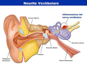 Neurite vestibolare