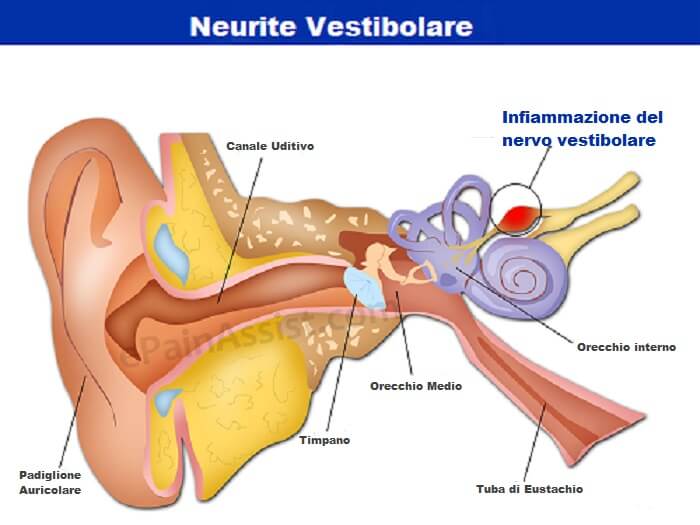 Neurite Vestibolare