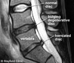 risonanza magnetica protrusione discale