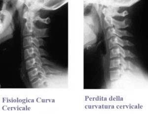 verticalizzazione cervicale