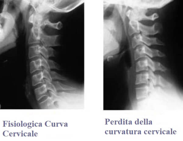 Verticalizzazione Cervicale