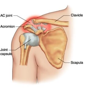 lussazione acromion claveare