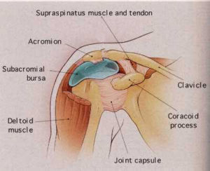 impingement subacromiale