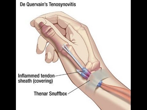 Sindrome di De Quervain