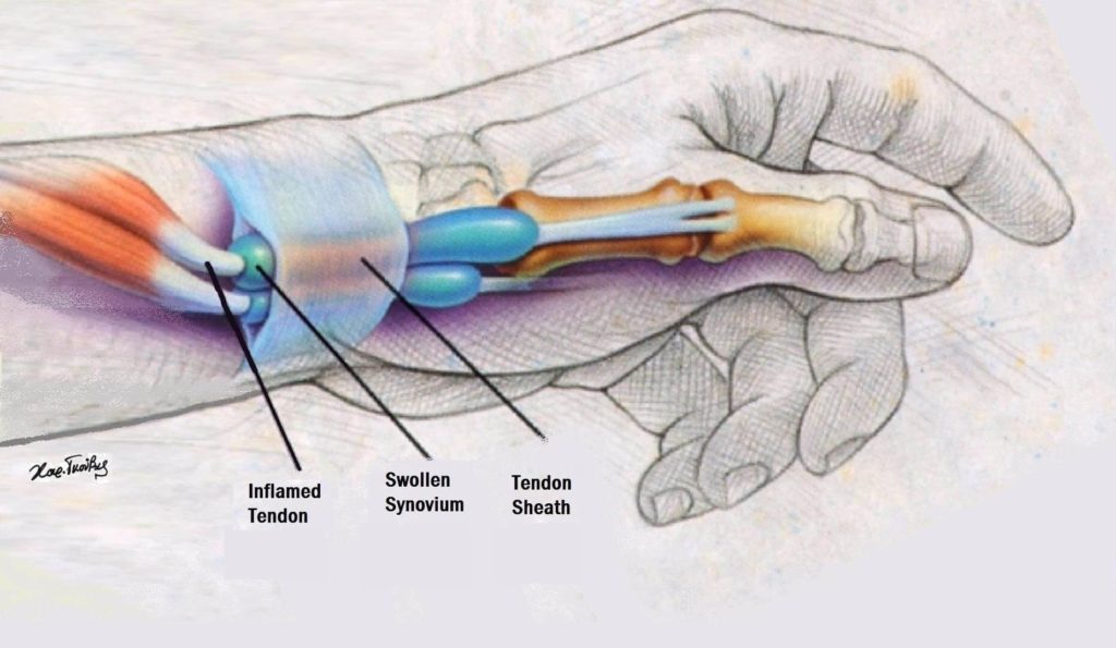tendinite de quervain