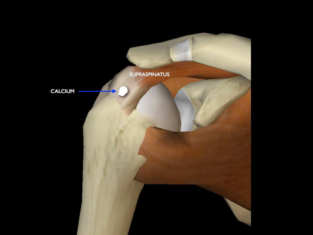 calcificazione tendine sovraspinato