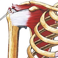 Lesione tendine sovraspinato