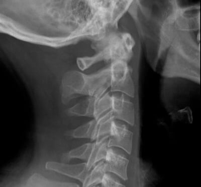 radiografia cervico occipitale