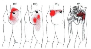 trigger point medio gluteo sacroileite