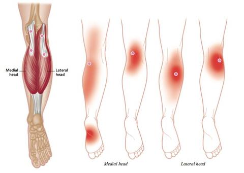 trigger point polpaccio