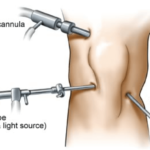 artroscopia ginocchio gonalgia