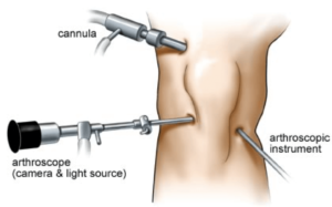 artroscopia ginocchio gonalgia