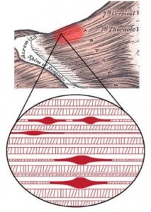 fibre trigger point