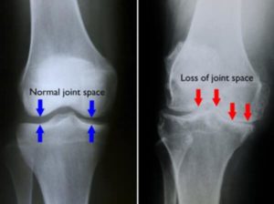 artrosi ginocchio RX