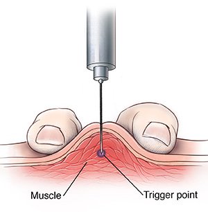 Disattivazione trigger point