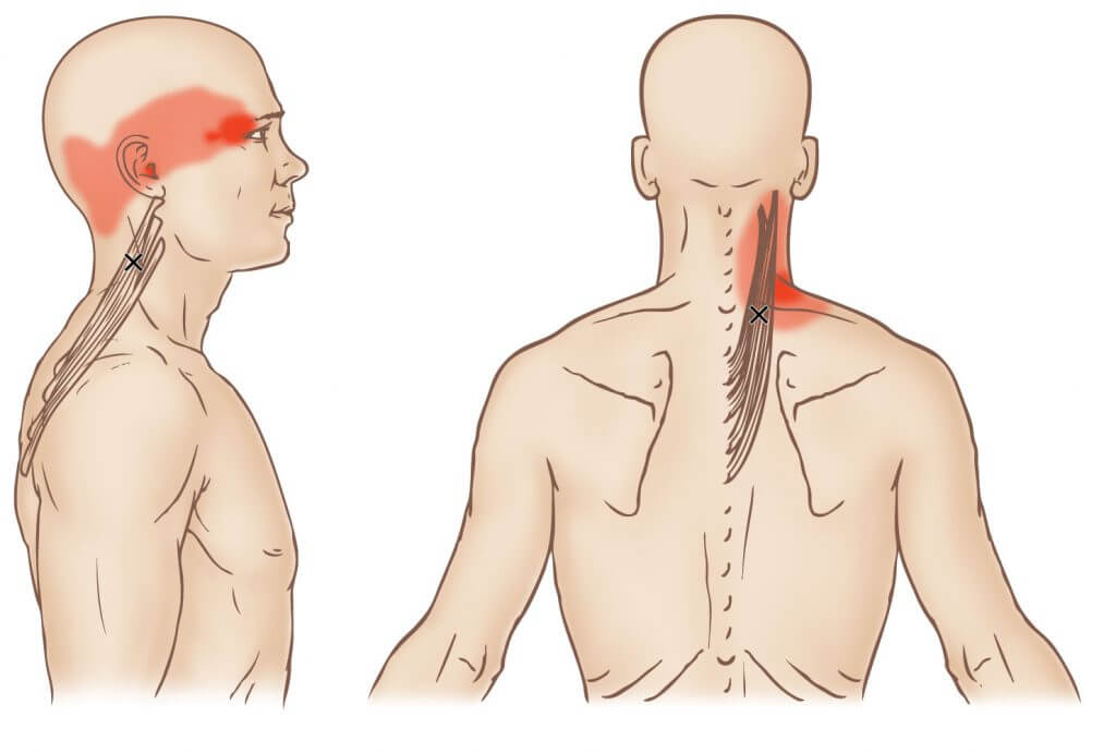 trigger point cervicale