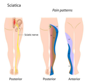 sciatica fino al piede