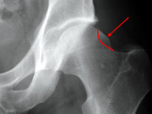 Lesione cam impingement femoro acetabolare