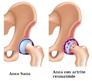 anca artrite reumatoide