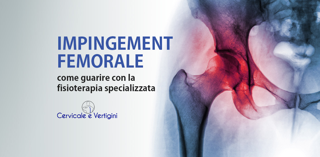 Impingement femoro acetabolare