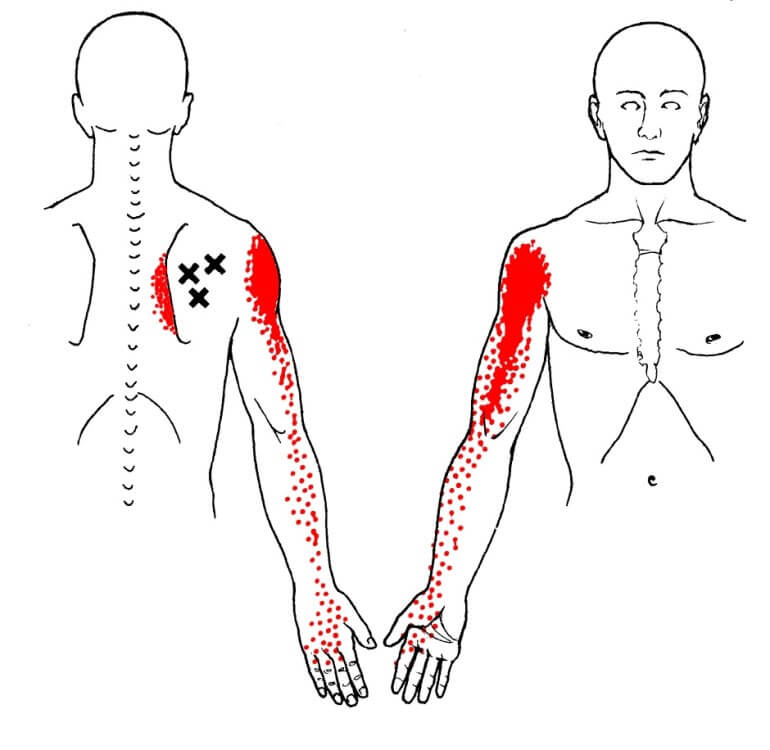 Area trigger point sottospinoso