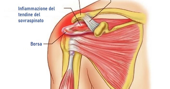 Tendinite Sovraspinato